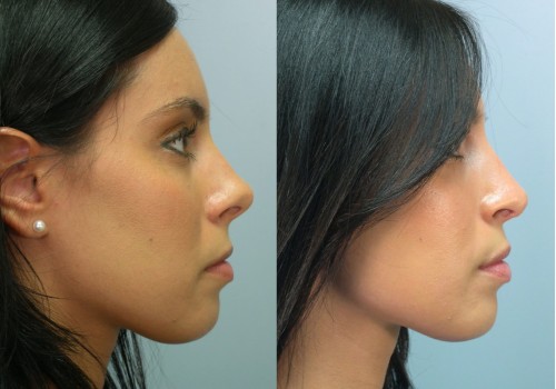 The Best Countries for Affordable Nose Surgery