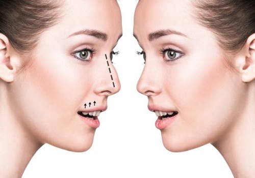 Get Expert Rhinoplasty From The Top Beverly Hills CA Nose Surgeon For Stunning Results